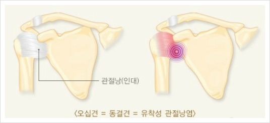 오십견(동결견)의 원인과 극복방법
