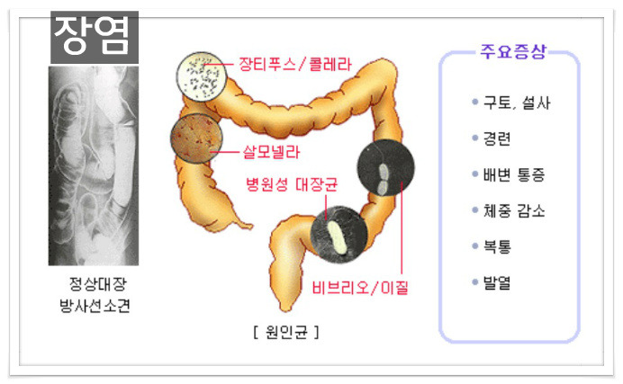 급성 장염 과 만성장염 식중독