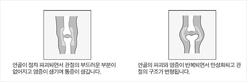 계단 운동, 등산, 오르는 것은 좋은데 내려올 때 관절염 위험?