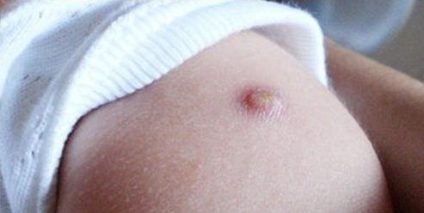 경피용 bcg 백신 비소 예방접종 도우미 사이트