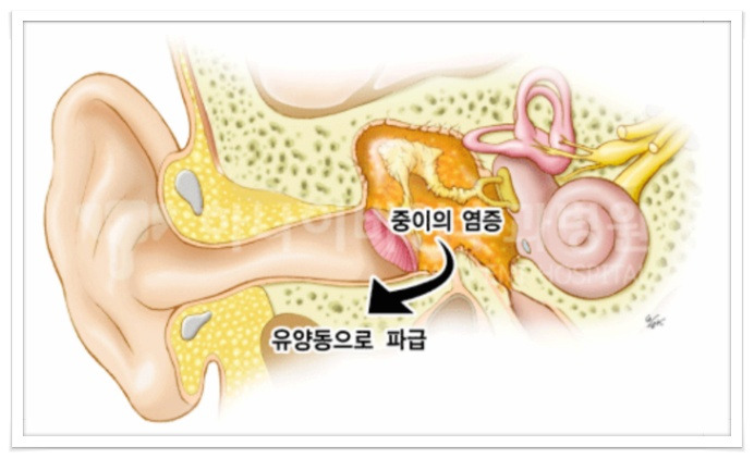 중이염 증상