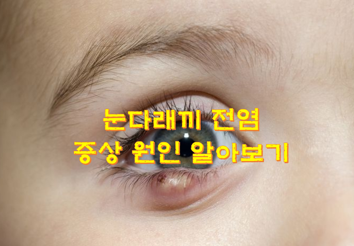 눈다래끼 전염 원인 치료방법