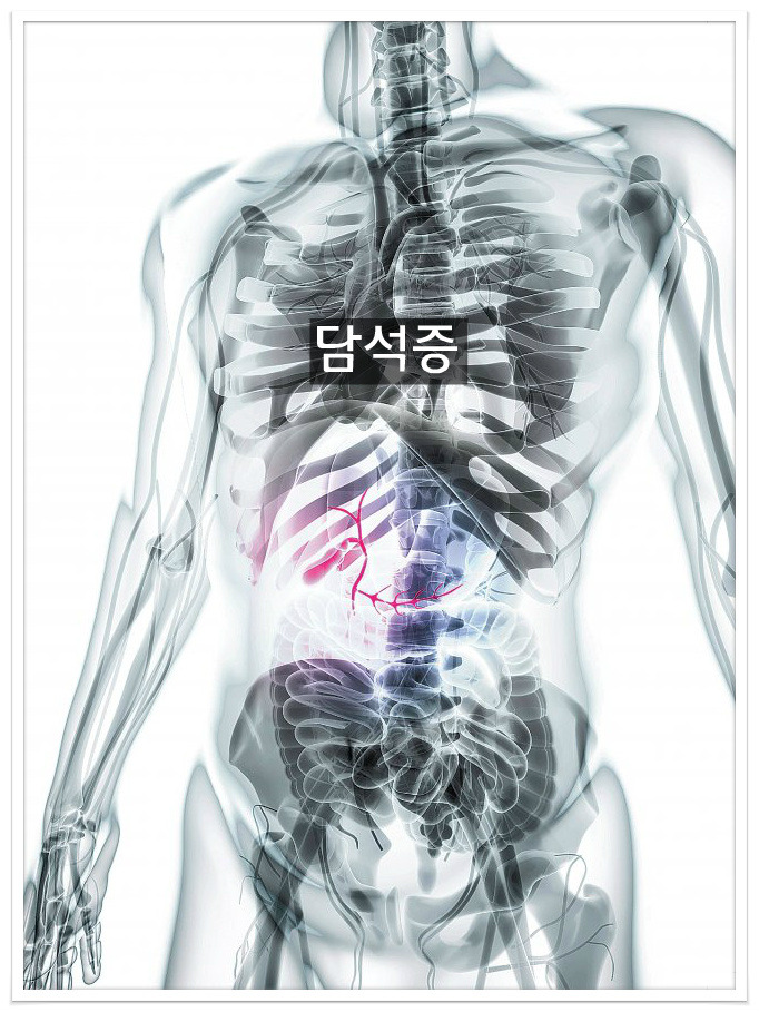 담석증의 원인