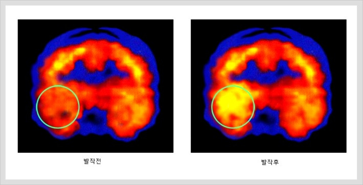 뇌전증이란?