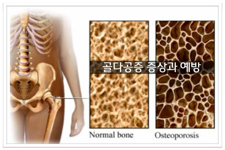 골다공증 증상과 예방