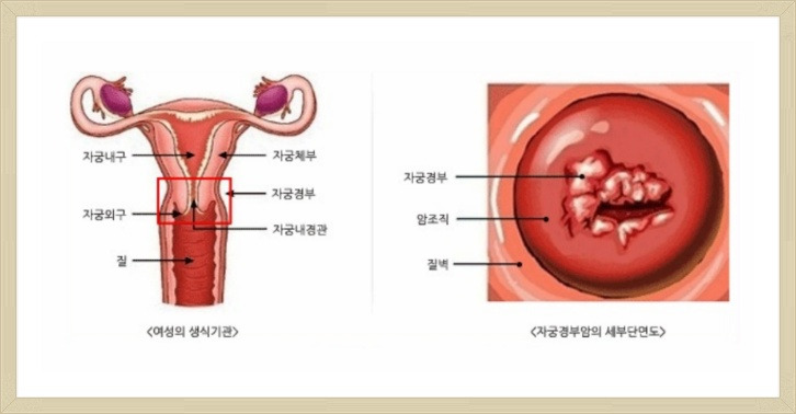 자궁경부암 증상과 예방방법