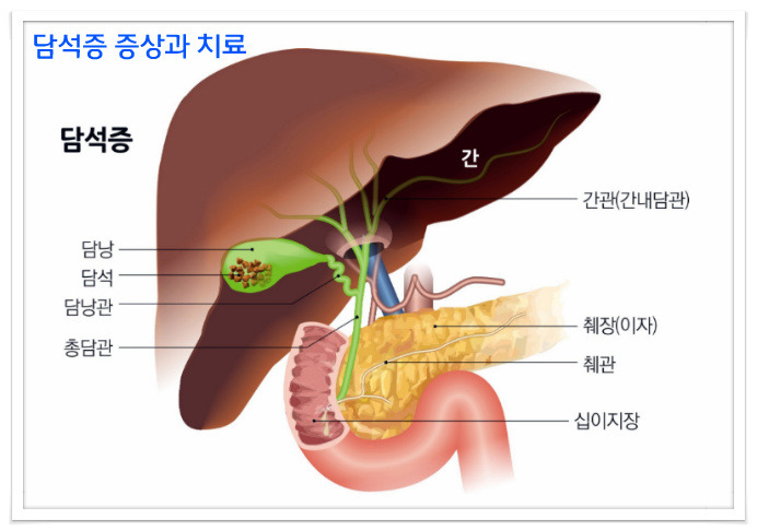 담석증 증상과 치료