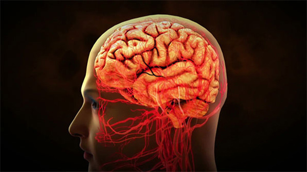 뇌경색 초기증상 및 예방법