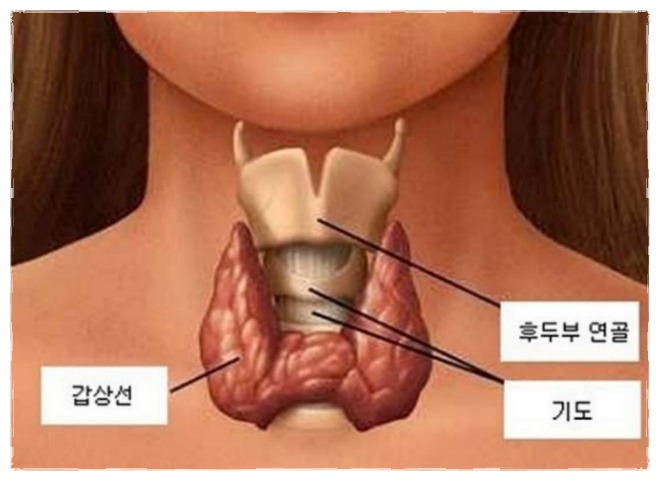 갑상선기능 항진증