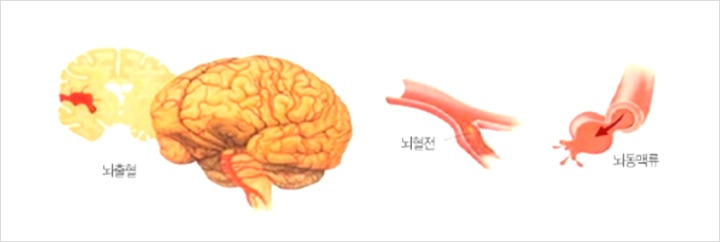 뇌졸증초기증세