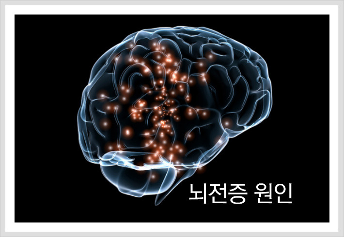 뇌전증의 원인