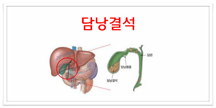 담낭 결석(담석)