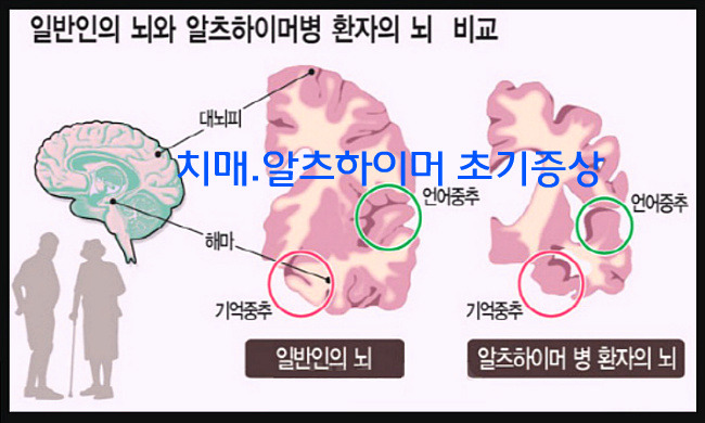 치매 알츠하이머 초기증상 예방