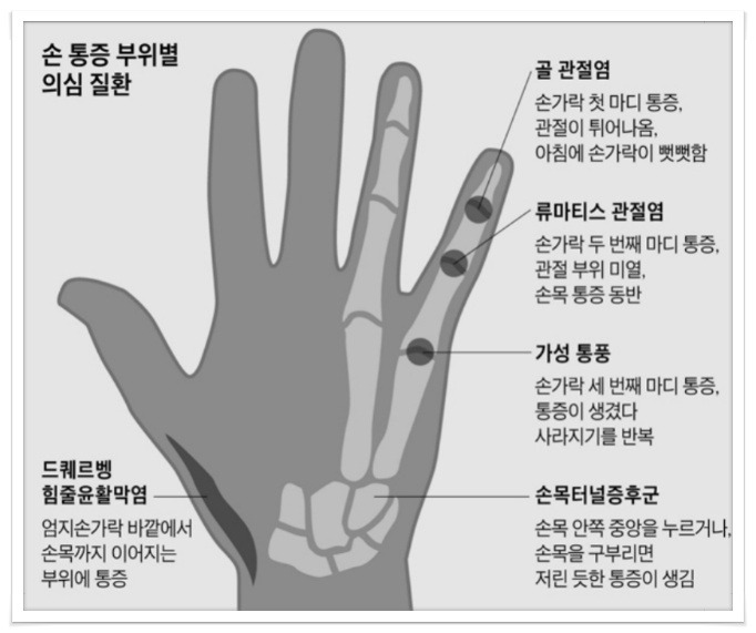 손가락마디 통증 류마티스관절염 의심