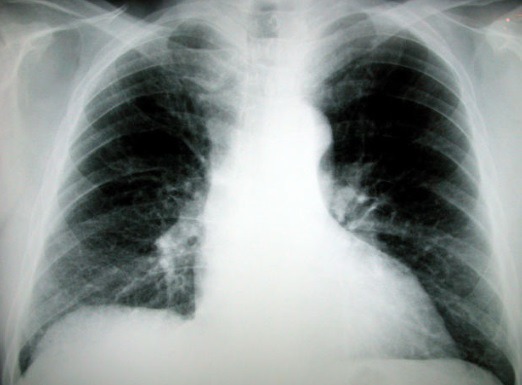 폐암 말기 증상과 4기 생존율은 어느 정도일까?