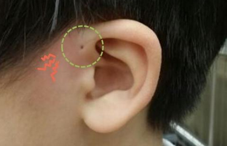 한국인 단 '3%'만 가지고 있다는 귀 옆 구멍의 정체