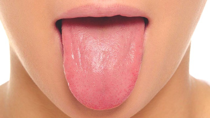 혀의 색깔에 따른 내 건강 상태 6가지