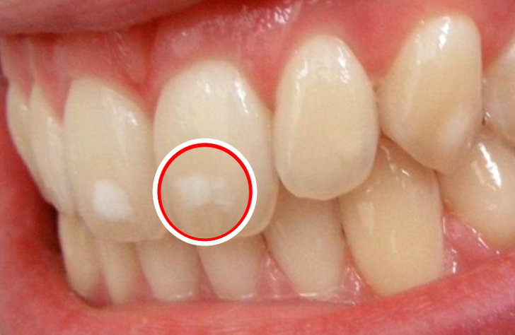 은근히 거슬렸던 치아에 있는 흰색점, 왜 생기는 걸까