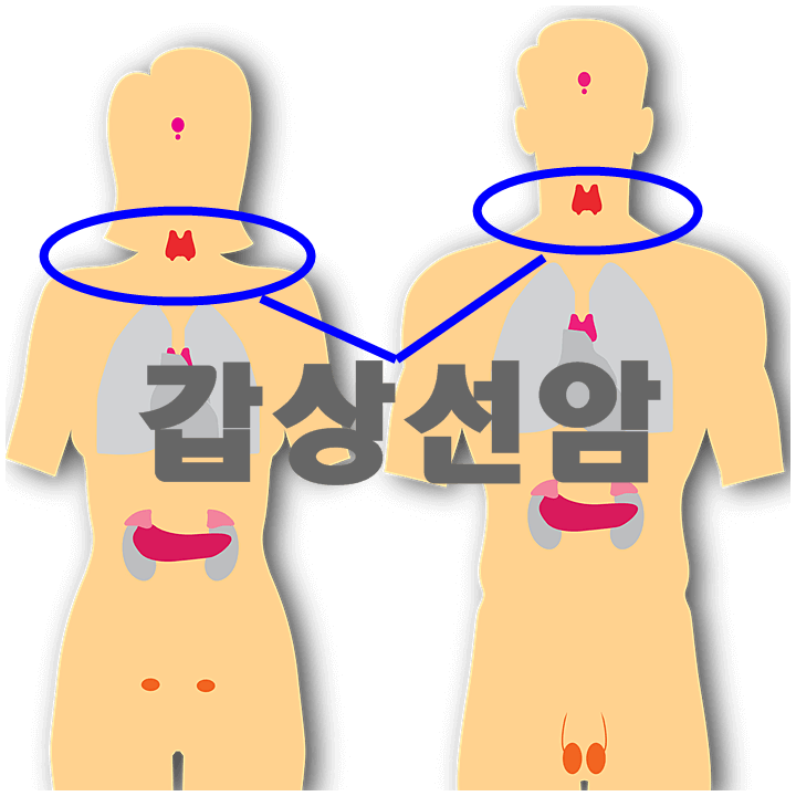 갑상선암, 착한 암은 개뿔! 당신을 배신하는 무서운암이다!