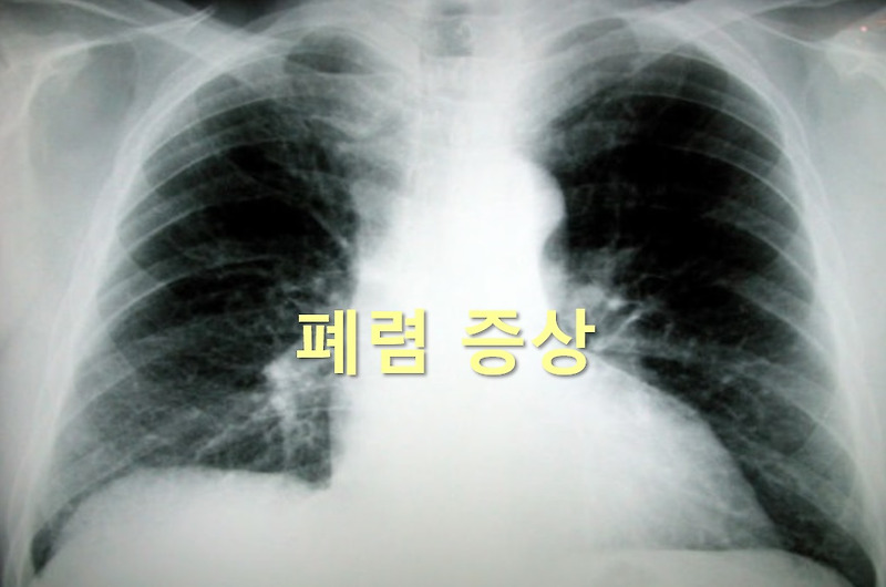폐렴 증상과 폐렴 예방접종 가격