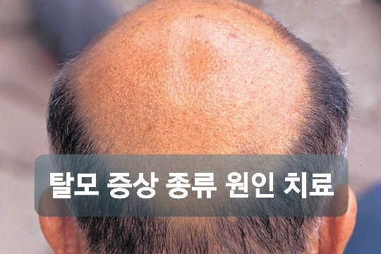 탈모 증상 종류 원인과 치료