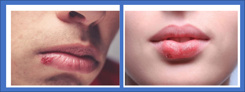 입술 수포 헤르페스 바이러스(단순 포진 )