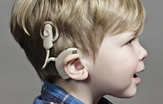 [연구] 청각장애 아동에 인공와우 착용의 긍정적효과