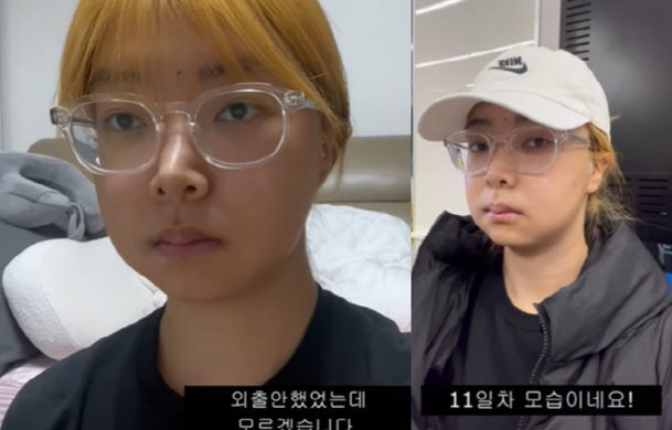나는솔로 10기 영자 양악 수술 후 달라진 얼굴공개 반응