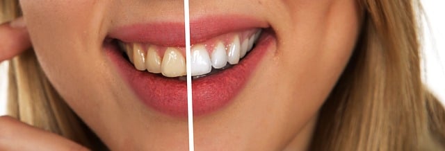 치아 변색 원인 및 치아 변색 치료 어떻게 하는지 알아보자!