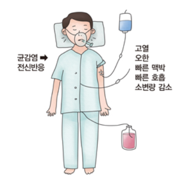 패혈증 증상과 치료방법