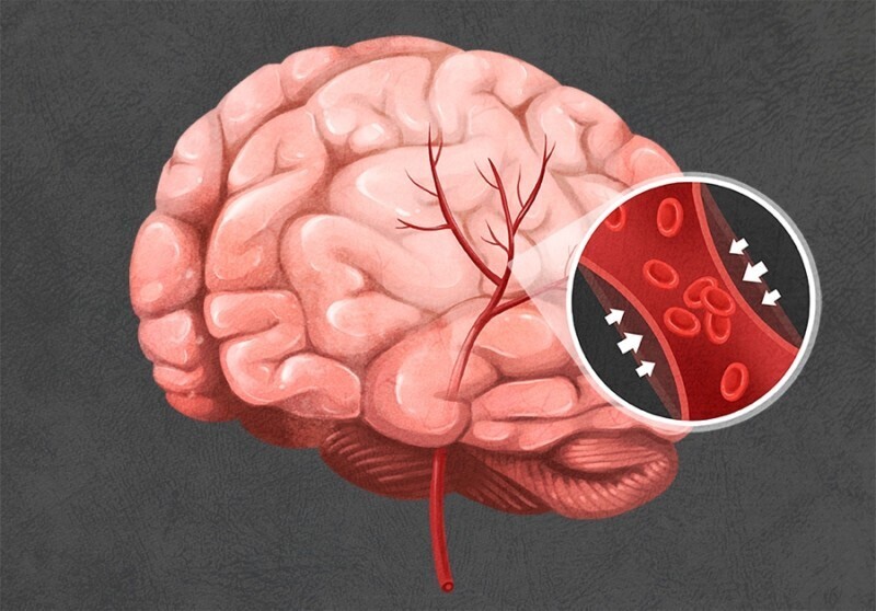 뇌경색 초기증상 7가지 및 치료방법