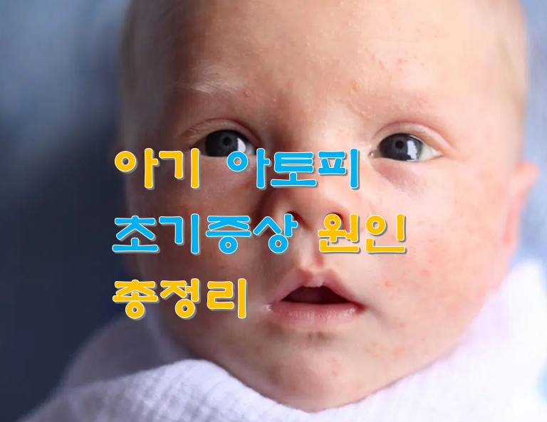 아기 아토피 초기증상 원인 총정리
