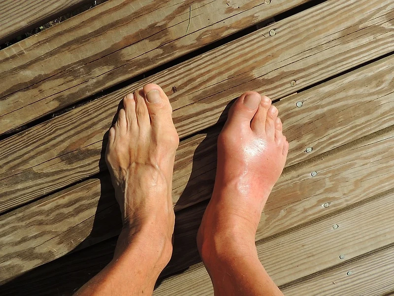 발가락, 발목에 찾아온 극심한 통증, 설마 통풍?