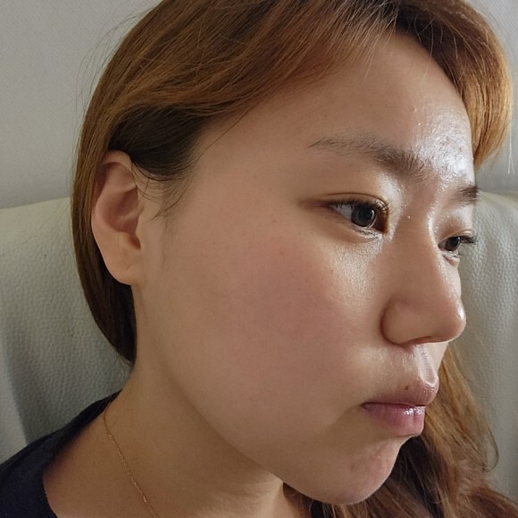 [3년만에 완전 바뀐 나의 여드름성 피부] PDT치료 후 바뀐 나의 피부 모습