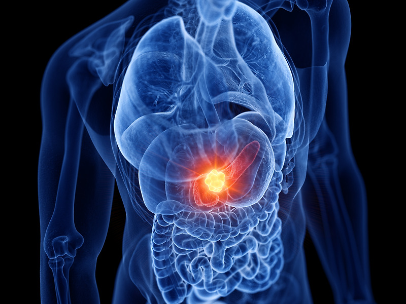 췌장암에 대한 이해: 초기증상, 검사, 완치율, 원인, 그리고 진행 단계