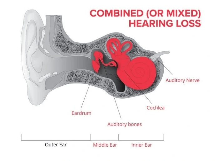 혼합성 청력손실, 원인과 증상, 치료에 대해 알아보기