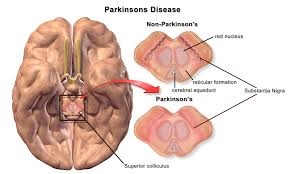 파킨슨병 수명과 원인 그리고 특징