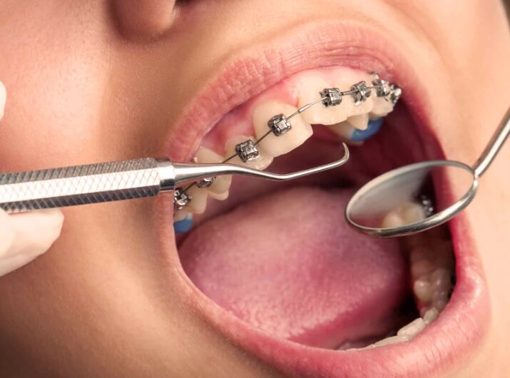 치아교정을 위한 여러가지 방법과 각 과정