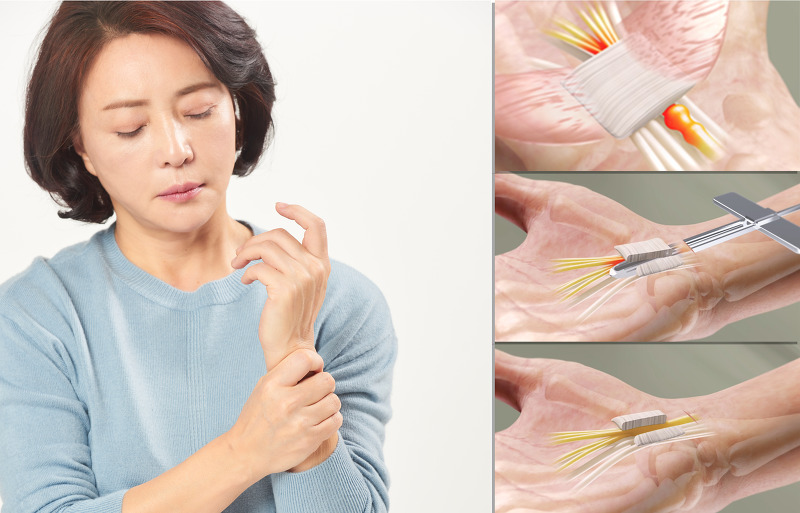 손목통증, 손저림 원인 증상 내시경수근관절개술 치료방법