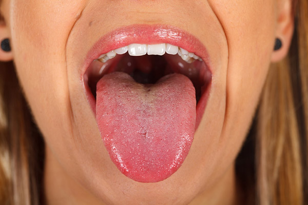 혀 갈라짐 원인과 증상 빠른 대처법