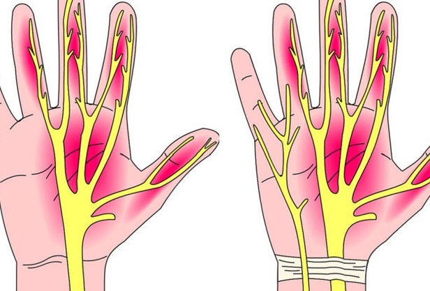 손목터널증후군 증상 및 손목 통증 원인, 자가 진단 입니다.