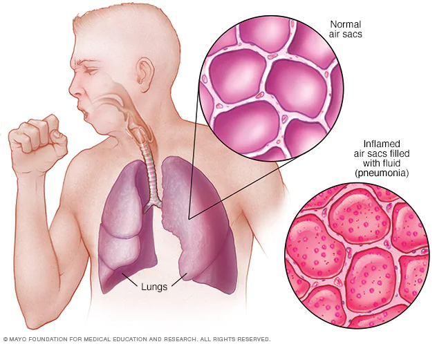 폐렴 원인 증상 및 치료 : 호흡기 감염에 의한 폐의 질병