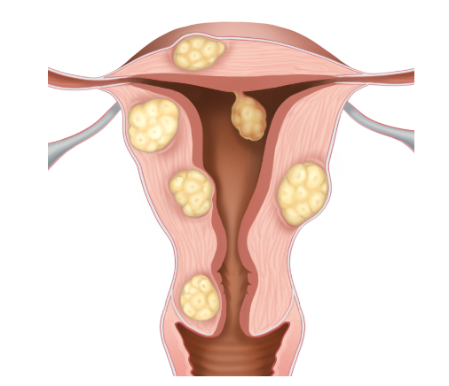 자궁근종 증상과 치료