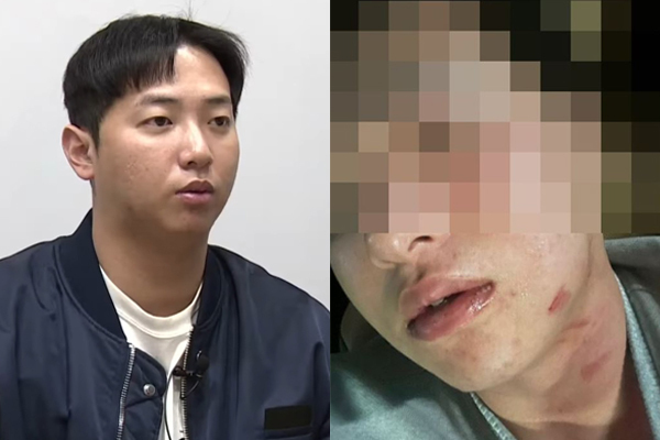 “김하성이 술만 먹으면 때렸다”…신상 밝히고 폭행사진 공개한 임혜동