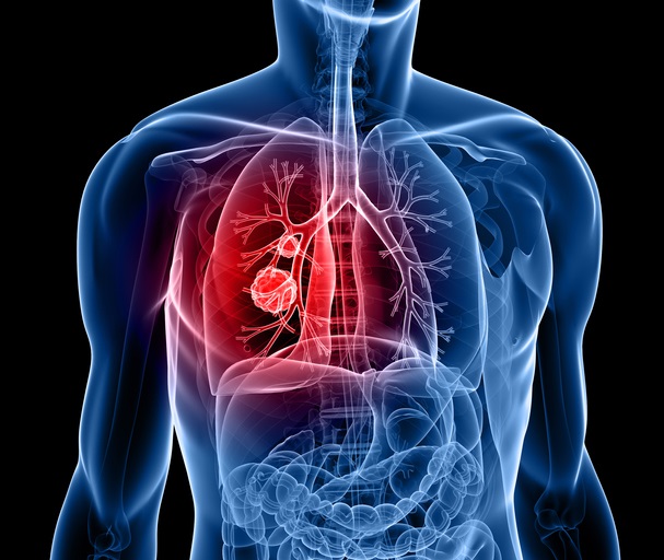 폐암의 예후