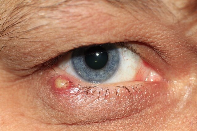 눈 대상포진 초기 증상 전염성여부, 예방접종가격