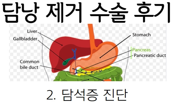 담낭 제거 수술 후기② : 담석증 진단