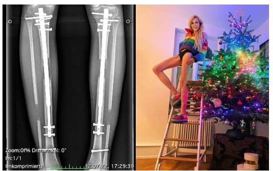 독일 모델 테레지아 피셔 '성공하고 싶어 다리 14cm 길어지는 사지 연장 수술'