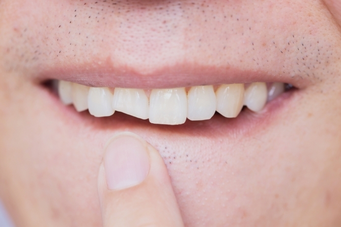 ‘치아 외상’ 환자, 활동 많아지는 봄에 증가