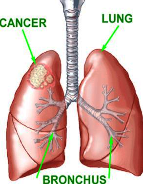폐암 원인, 초기증상, 치료, 예방법